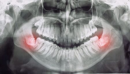 How to Regrow Bone Around Teeth Naturally?